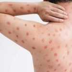 Ministerio de Salud Pública (MSP) confirmó un caso de viruela símica