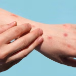 ¿Cuáles son los síntomas de la viruela símica detectada en Ecuador?