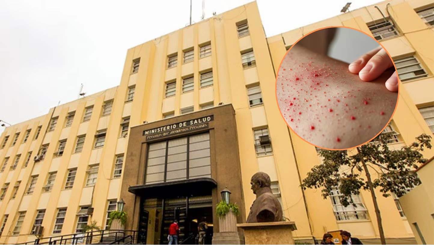 El decreto de emergencia sanitaria responde a la alerta epidemiológica AE-CDC-Nº005-2025, que advierte peligro de expansión del sarampión. (Andina)