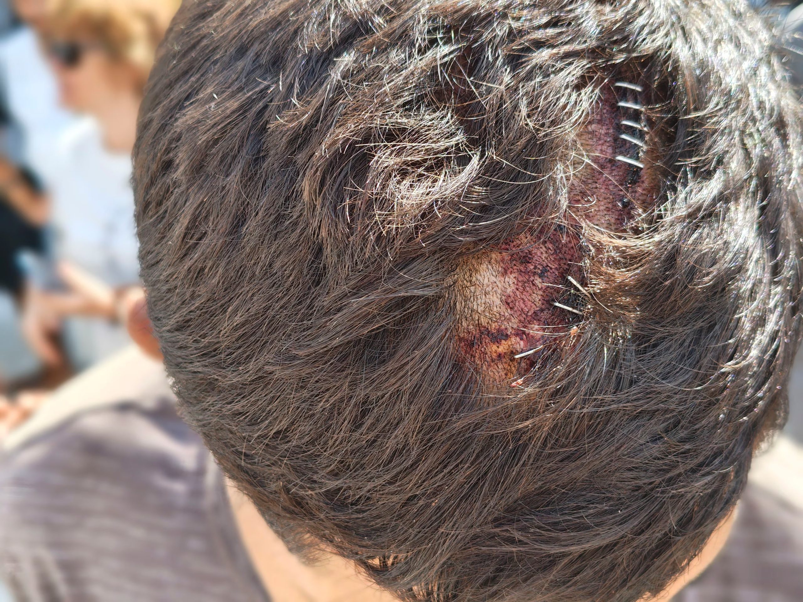 Un migrante en Ceuta muestra sus heridas, agredido por militares españoles, según Amnistía Internacional. (EFE/AI)