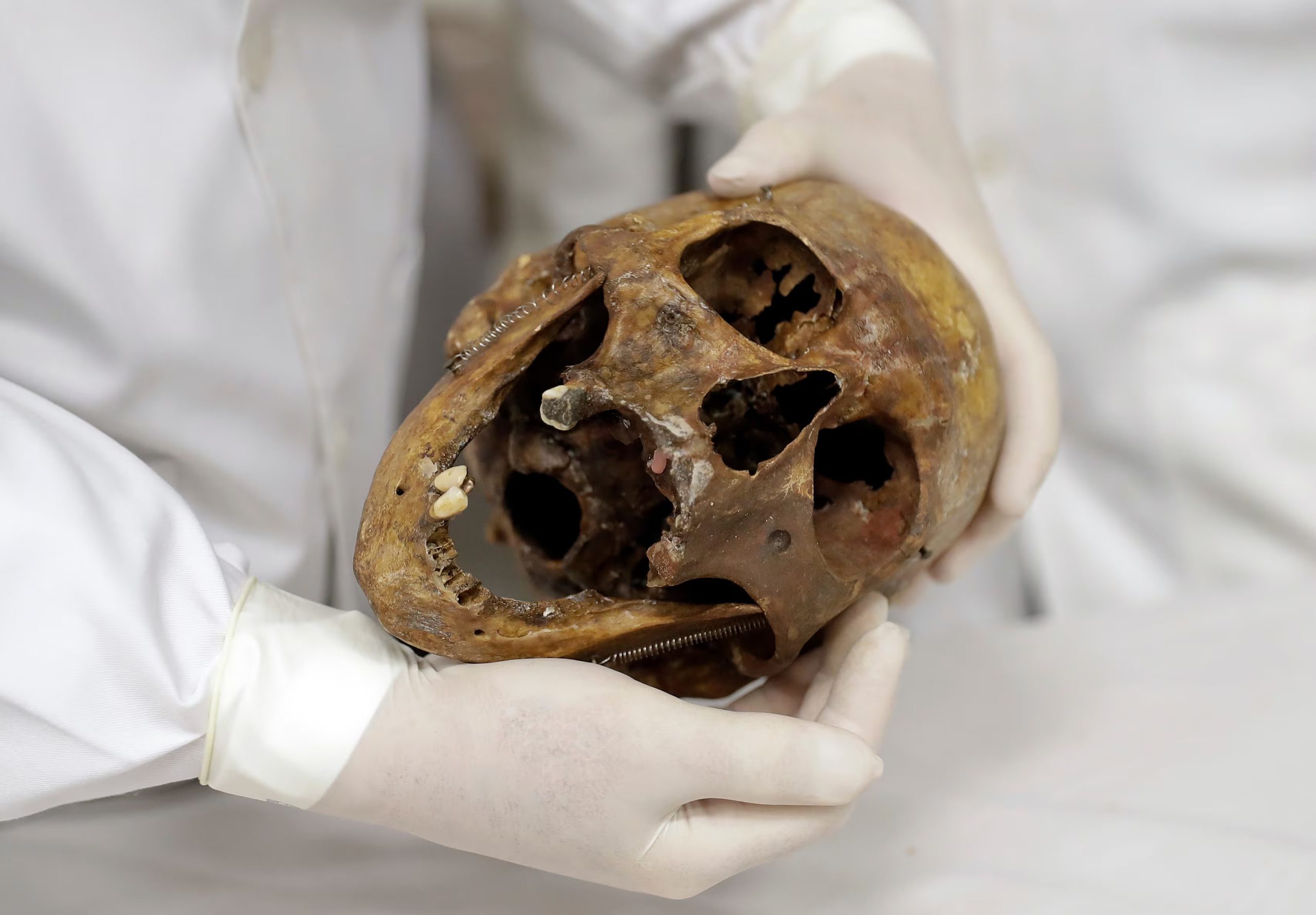 En esta fotografía del sábado 7 de diciembre de 2016, el médico forense Daniel Muñoz muestra el cráneo del criminal de guerra nazi Josef Mengele, en la Facultad de Medicina de la Universidad de São Paulo, en São Paulo, Brasil (Foto AP/Andre Penner, Archivo)